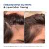 71cqx5AaYPL._SL1200_ WishCare Hair Growth Serum Roll On For Scalp | 94% Saw New Hair Growth | Redensyl & Rosemary Oil | 100% Saw Hairfall Reduction | In-Vivo Tested | For Men & Women | 10ml